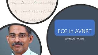 ECG in AVNRT [upl. by Amitaf]