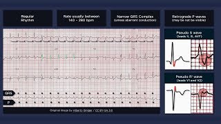 Atrioventricular Nodal Reentry Tachycardia AVNRT ECG [upl. by Asiuqram]