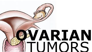 Ovarian Pathology amp Tumors [upl. by Ambrogio764]