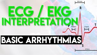 AV Nodal ReEntrant Tachycardia AVNRT  Pathophysiology Typical Versus Atypical ECG Diagnosis [upl. by Emarej]