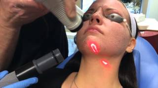 Recovery After CO2 Laser Facial [upl. by Lot]