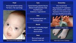 Down Syndrome Dysmorphic Features [upl. by Pennington767]