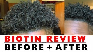 BIOTIN Hair Growth Results Before and After [upl. by Morse]