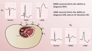 Advanced EKGs  WolffParkinsonWhite WPW Syndrome [upl. by Htennek]