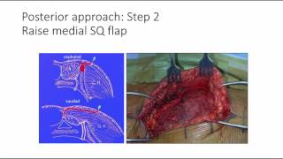 Sacral fractures 2  surgical techniques and dysmorphism [upl. by Nivram]